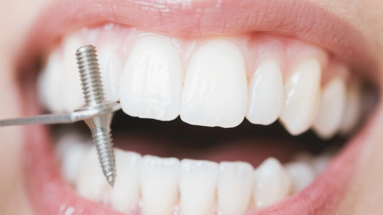 Cost of Dental Implants Nearby