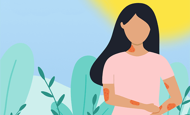 Managing Plaque Psoriasis: Effective Treatment and Recognizing Symptoms