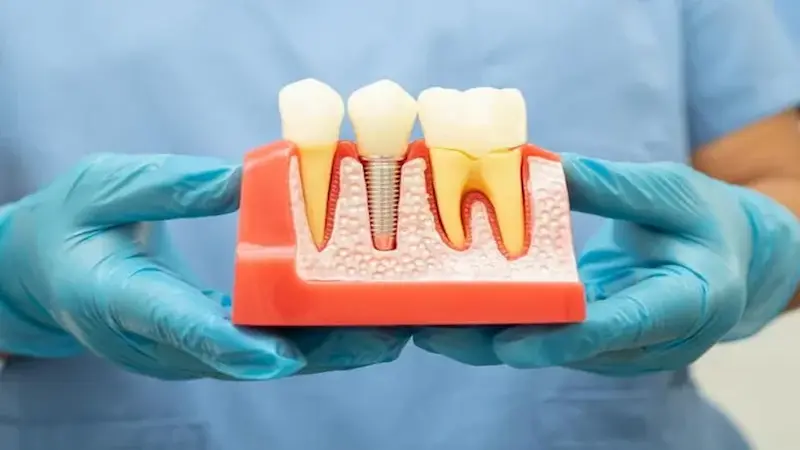 Exciting News: Get Your Dental Implants for Affordable with Medicare Coverage!