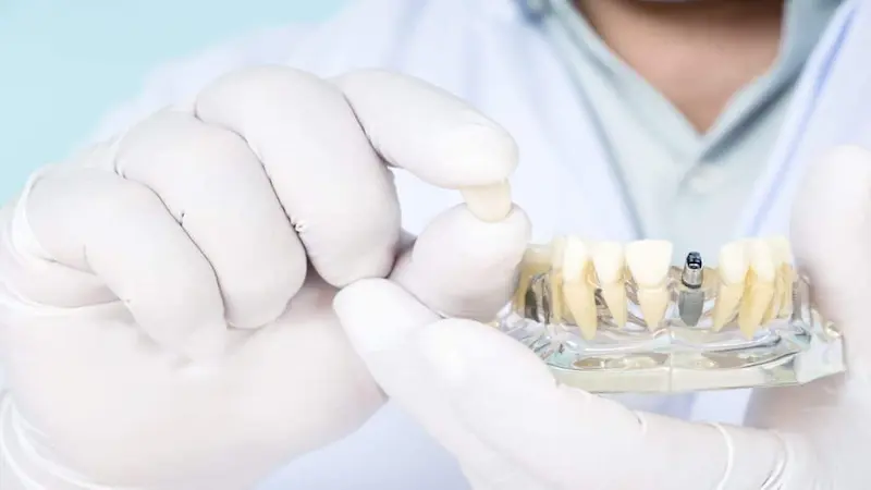 Understanding Dental Implants, Medicare, and Coverage Options
